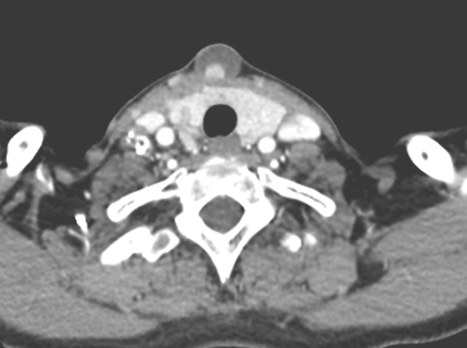 /uploads/image/2025-05-26/160652288图3 颈部增强CT示颈前正中类圆形低密度影内的强化结节影.jpg 图3 颈部增强CT示颈前正中类圆形低密度影内的强化结节影